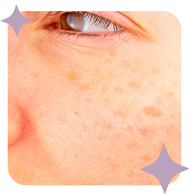 Melasma na gravidez